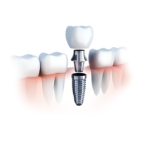 Illustrazione Impianto + Corona in zirconio - Trattamento dentale disponibile presso le Cliniche Francesco Saba